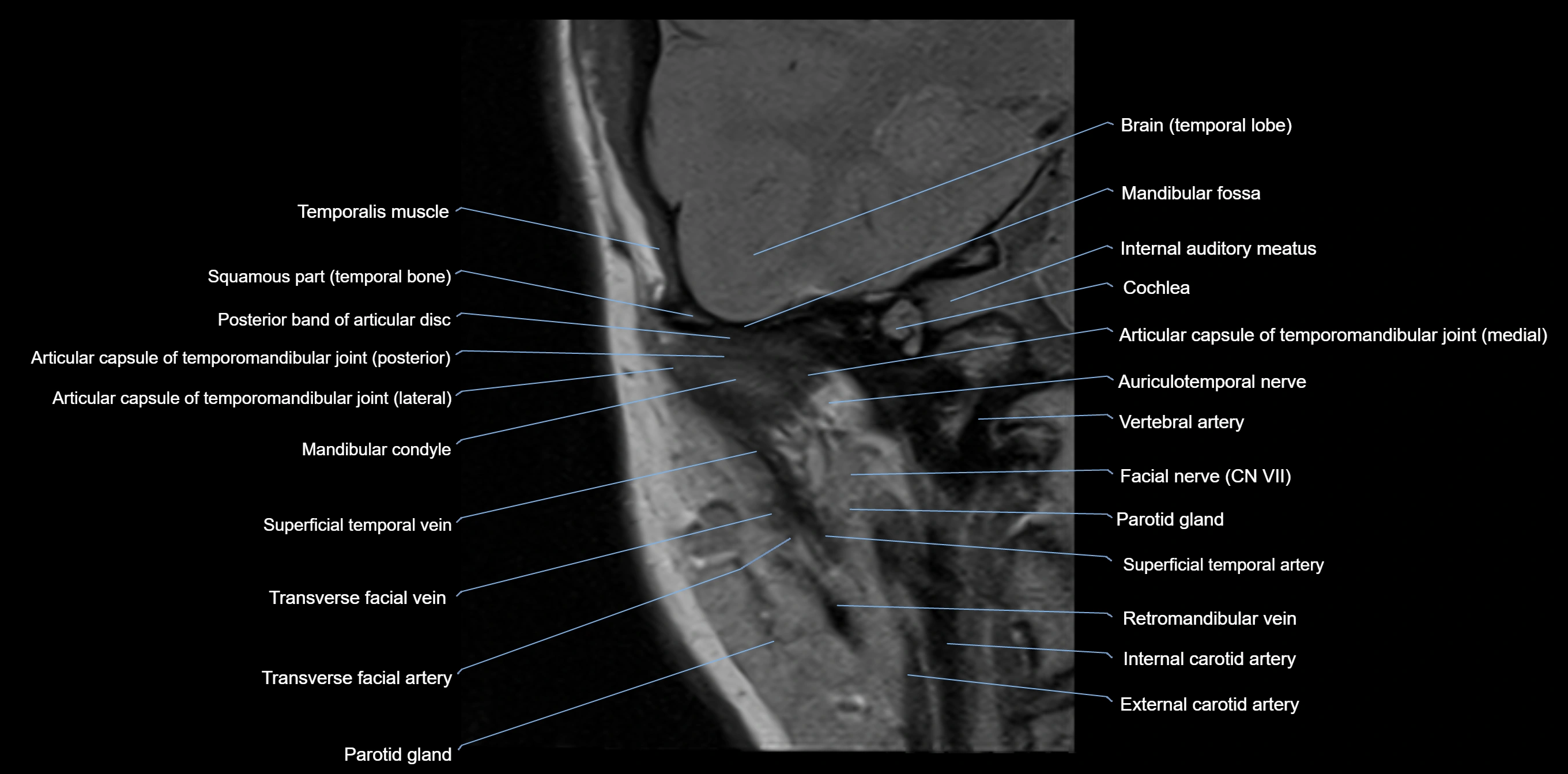 MRI TMJ coronal cross sectional 3T anatomy -img-00004-00009.webp